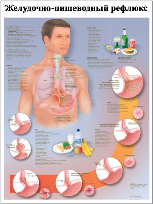ZVR6711L Желудочно-пищеводный рефлюкс ZVR6711L Желудочно-пищеводный рефлюкс