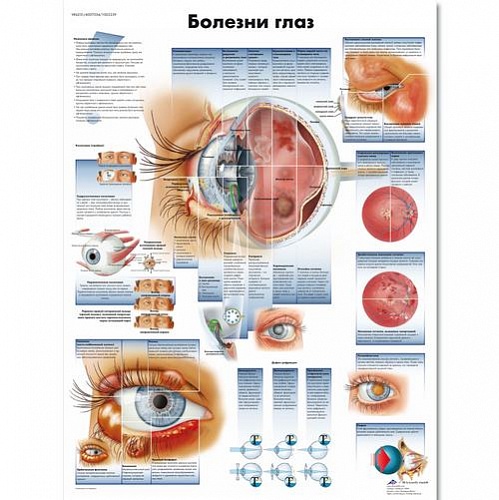 ZVR6231L Болезни глаз
